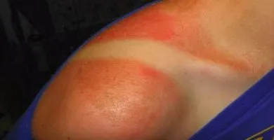 quemadas-sol-cielo-nublado